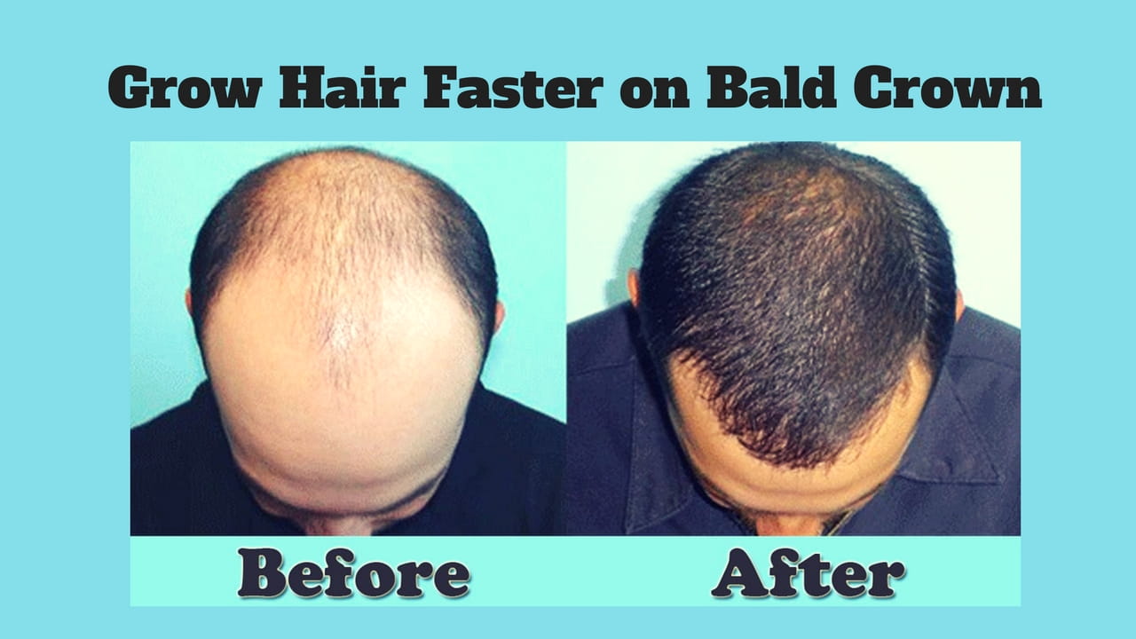 Ganje Sir Par Jaldi Baal Agane Ke Asan Aur Faida Mand Tareeqe - How to regrow hair on a bald spot fast?