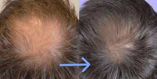 Tin Hafton Mein Kudrati Tareeqon Se Baalon Ki Nashaonuma Kaise Hasil Karein? - How can I regrow my hair in 3 weeks naturally?